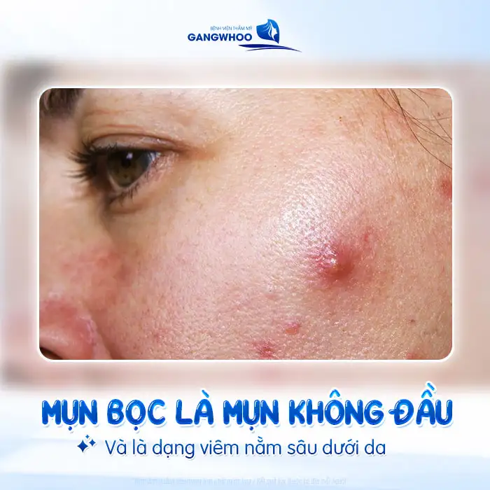 Cách điều trị mụn bọc không đầu nhanh xẹp, an toàn tại nhà