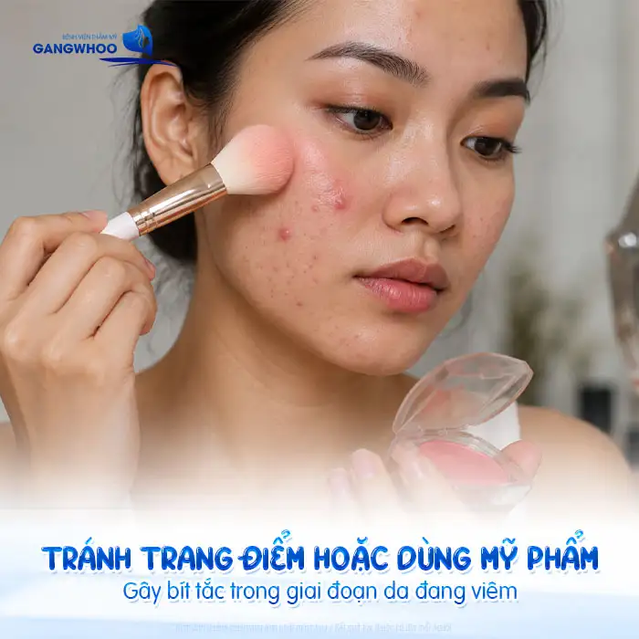 Cách điều trị mụn bọc không đầu nhanh xẹp, an toàn tại nhà