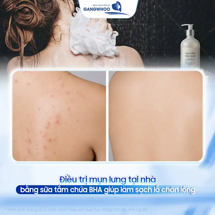 Nguyên nhân gây mụn lưng và cách điều trị mụn lưng hiệu quả