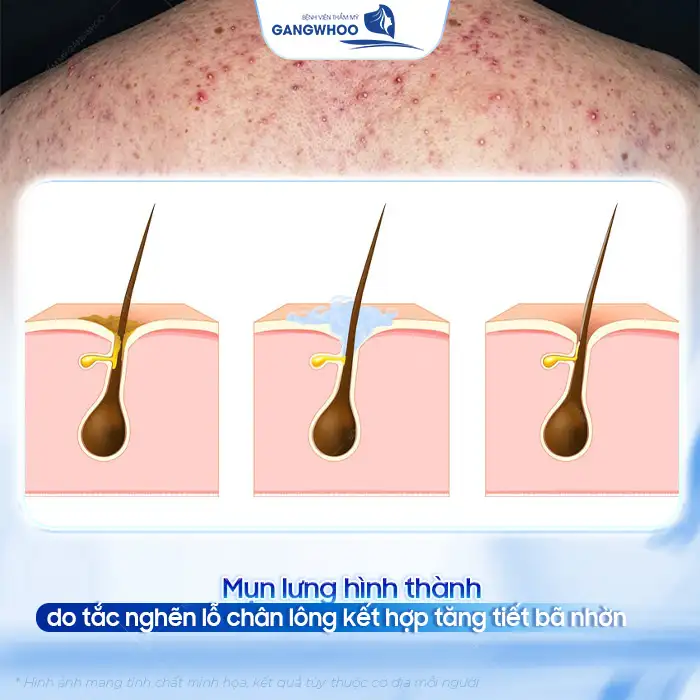 Nguyên nhân gây mụn lưng và cách điều trị mụn lưng hiệu quả