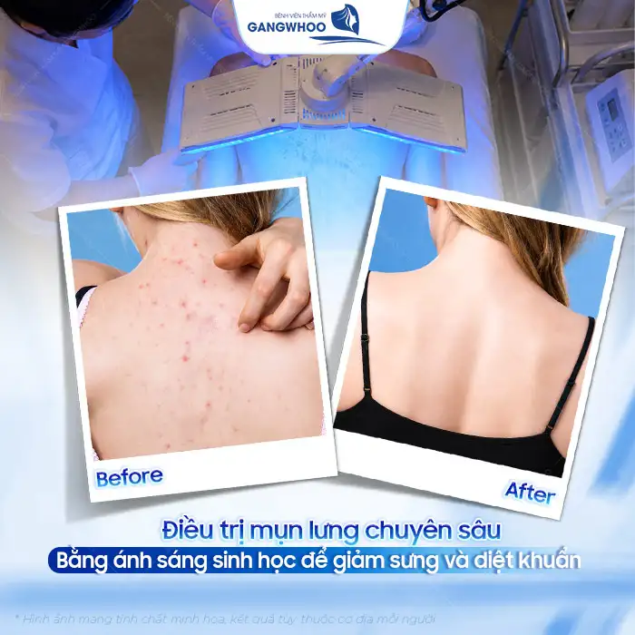 Nguyên nhân gây mụn lưng và cách điều trị mụn lưng hiệu quả