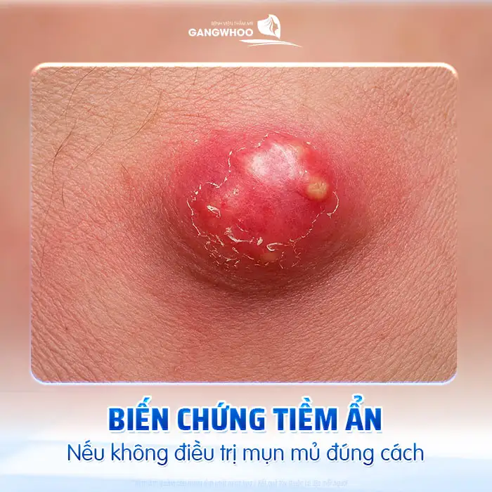 Cách điều trị mụn mủ an toàn, tránh lan rộng và nhiễm trùng