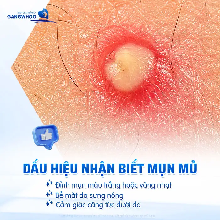 Cách điều trị mụn mủ an toàn, tránh lan rộng và nhiễm trùng