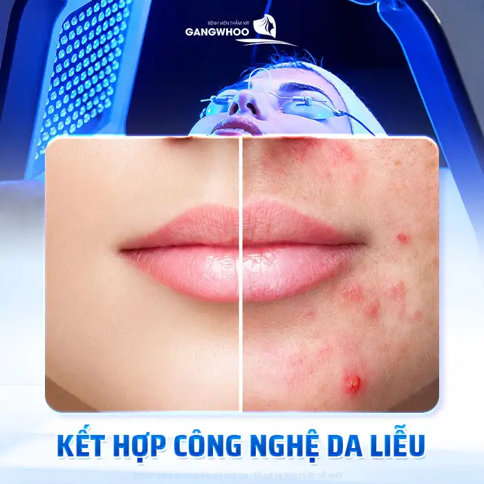 Cách điều trị mụn mủ an toàn, tránh lan rộng và nhiễm trùng