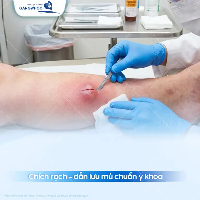 Cách điều trị mụn nhọt an toàn, hiệu quả và không để lại sẹo