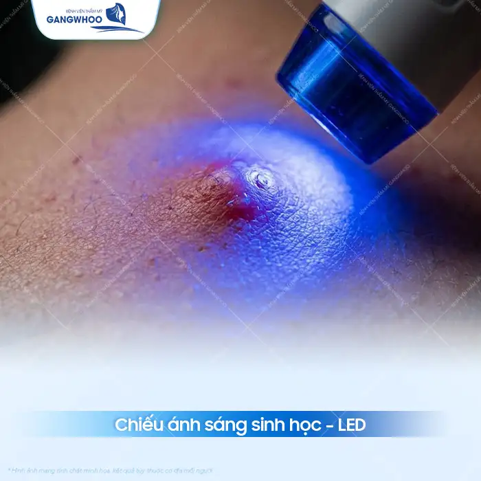 Cách điều trị mụn nhọt an toàn, hiệu quả và không để lại sẹo