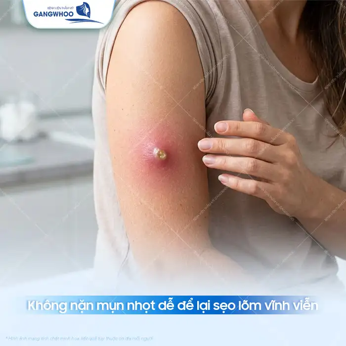 Cách điều trị mụn nhọt an toàn, hiệu quả và không để lại sẹo