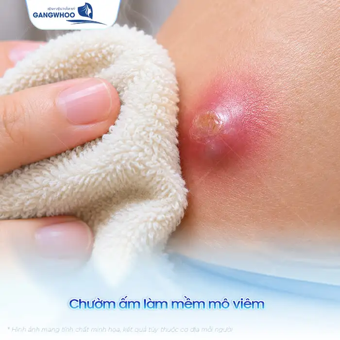 Cách điều trị mụn nhọt ở mông nhanh lành và không để lại thâm