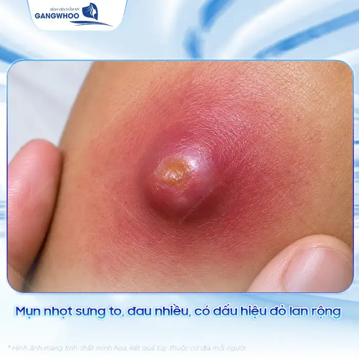 Cách điều trị mụn nhọt ở mông nhanh lành và không để lại thâm