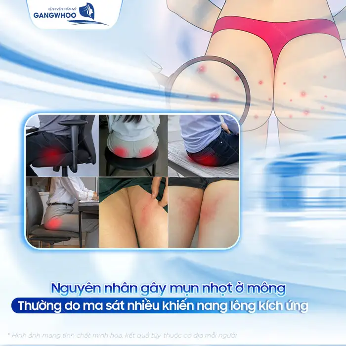 Cách điều trị mụn nhọt ở mông nhanh lành và không để lại thâm