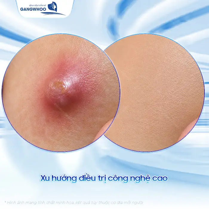 Cách điều trị mụn nhọt ở mông nhanh lành và không để lại thâm