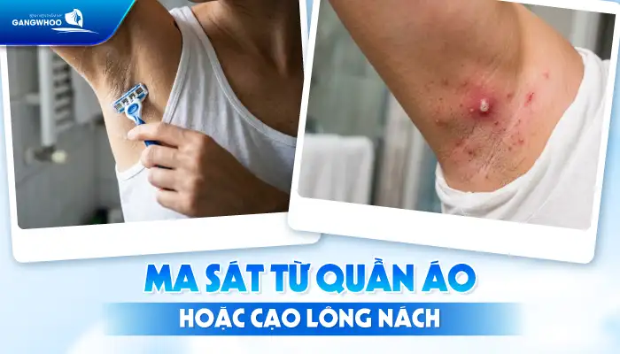 Cách điều trị mụn nhọt ở nách nhanh khỏi, không để lại thâm sẹo