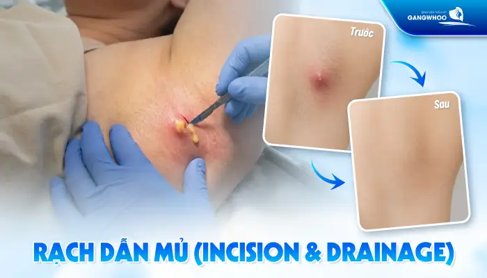 Cách điều trị mụn nhọt ở nách nhanh khỏi, không để lại thâm sẹo
