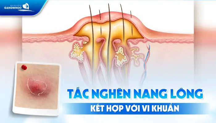 Cách điều trị mụn nhọt ở nách nhanh khỏi, không để lại thâm sẹo