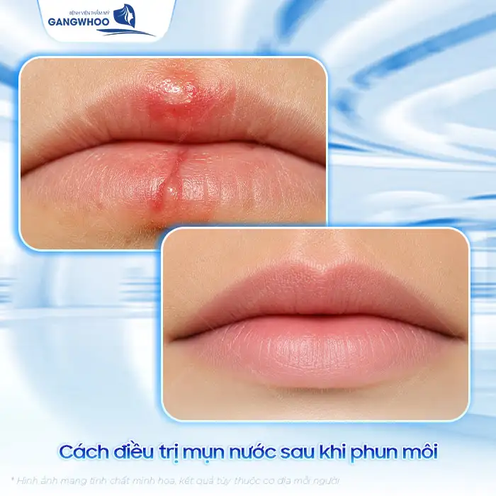 Cách điều trị mụn nước sau khi phun môi hiệu quả, an toàn