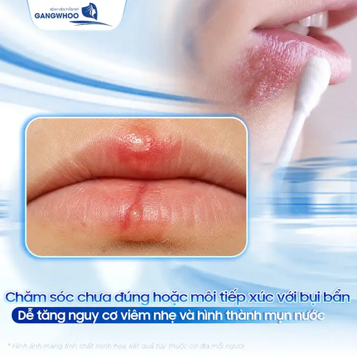 Cách điều trị mụn nước sau khi phun môi hiệu quả, an toàn