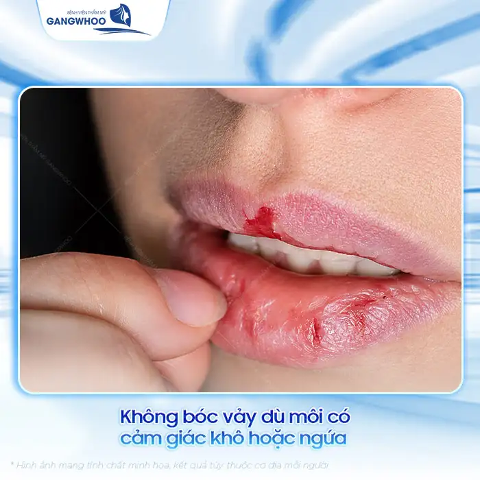 Cách điều trị mụn nước sau khi phun môi hiệu quả, an toàn