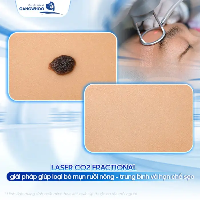 Cách điều trị mụn ruồi an toàn, tránh biến chứng nguy hiểm