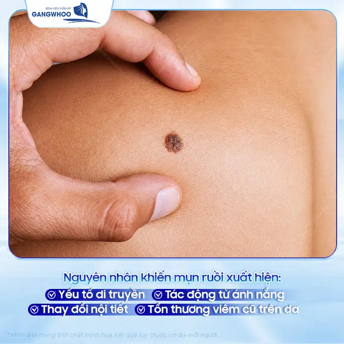 Cách điều trị mụn ruồi an toàn, tránh biến chứng nguy hiểm