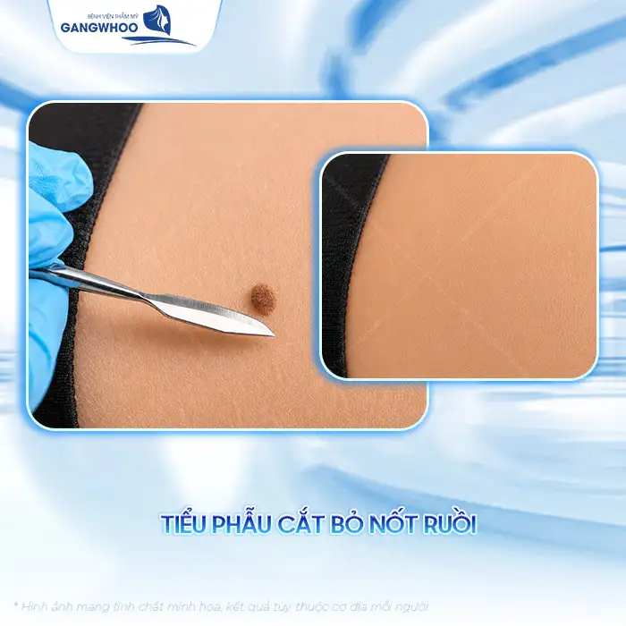 Cách điều trị mụn ruồi an toàn, tránh biến chứng nguy hiểm