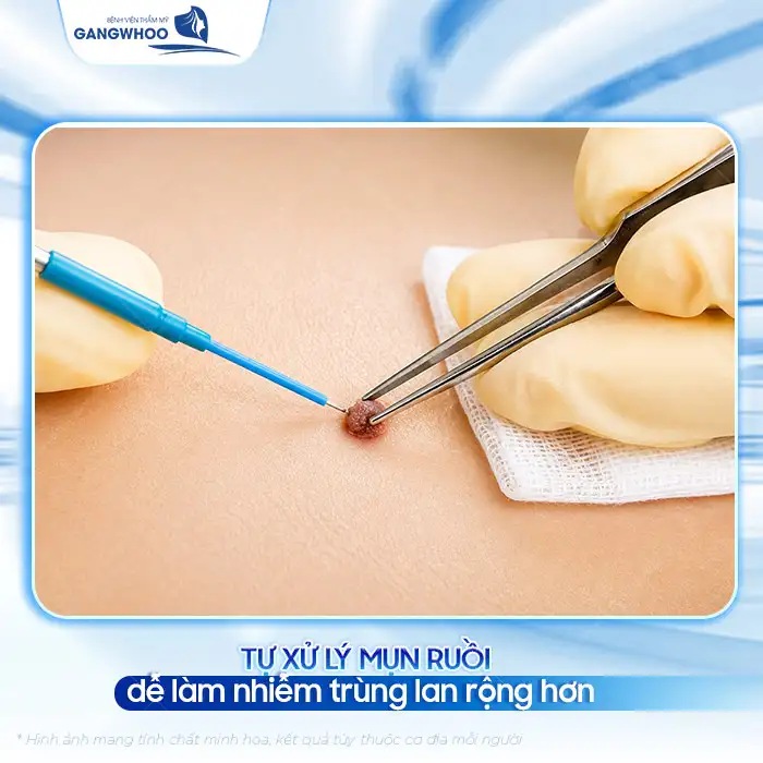 Cách điều trị mụn ruồi an toàn, tránh biến chứng nguy hiểm