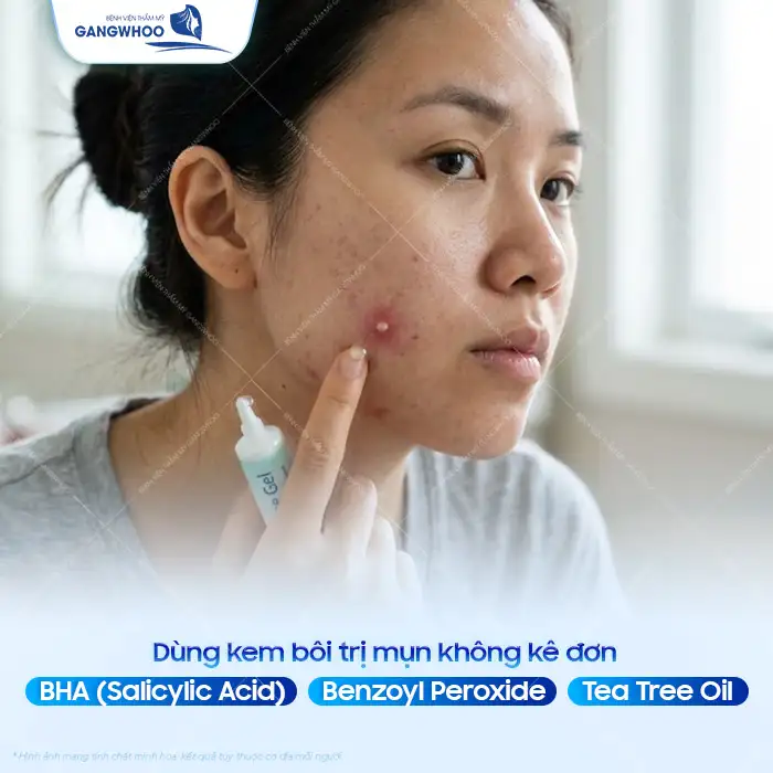 11+ Cách điều trị mụn tại nhà hiệu quả và an toàn cho da