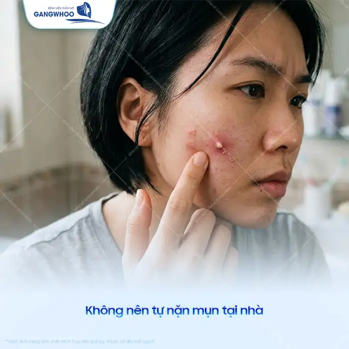11+ Cách điều trị mụn tại nhà hiệu quả và an toàn cho da