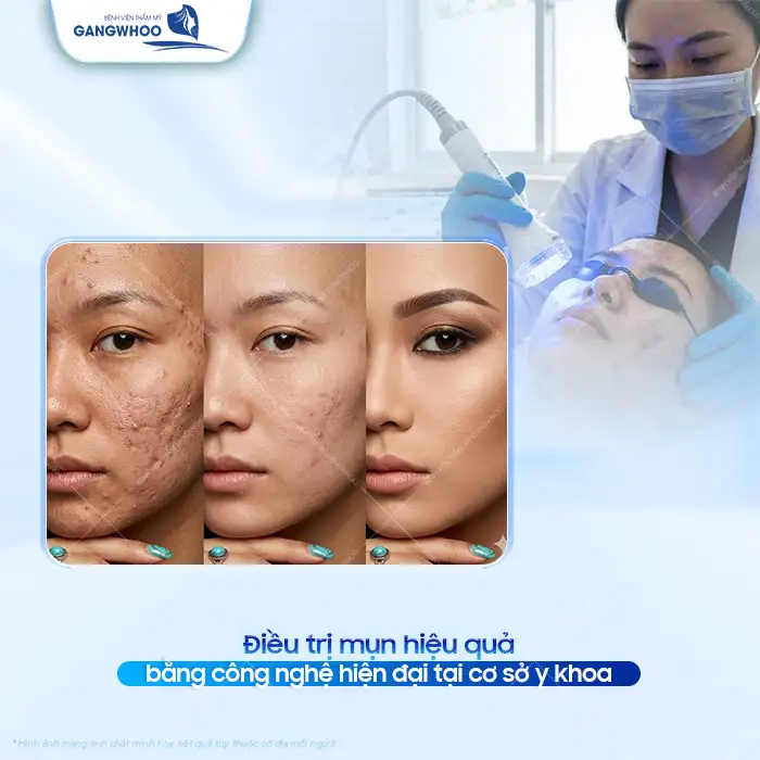 11+ Cách điều trị mụn tại nhà hiệu quả và an toàn cho da