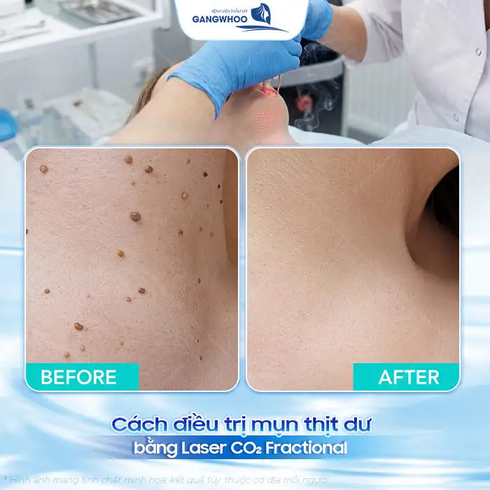 Cách điều trị mụn thịt dư hiệu quả không để lại sẹo xấu