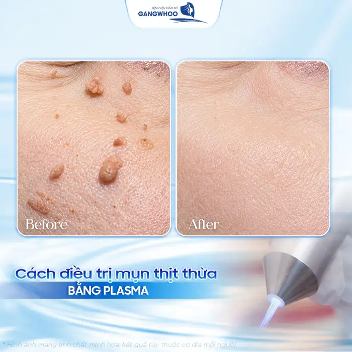 Cách điều trị mụn thịt dư hiệu quả không để lại sẹo xấu