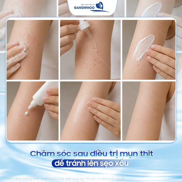 Cách điều trị mụn thịt dư hiệu quả không để lại sẹo xấu