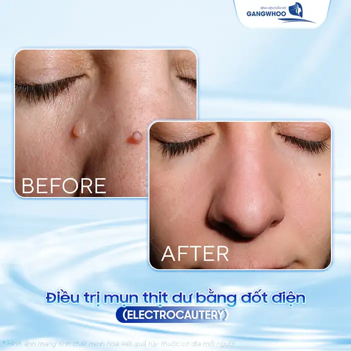 Cách điều trị mụn thịt dư hiệu quả không để lại sẹo xấu