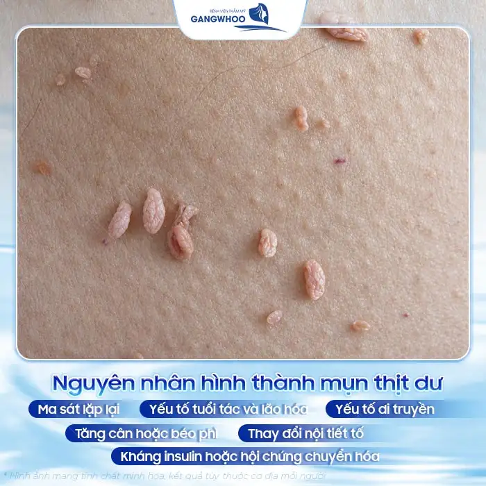 Cách điều trị mụn thịt dư hiệu quả không để lại sẹo xấu