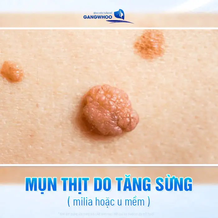 Cách điều trị mụn thịt ở vùng kín đúng cách, không gây viêm nhiễm