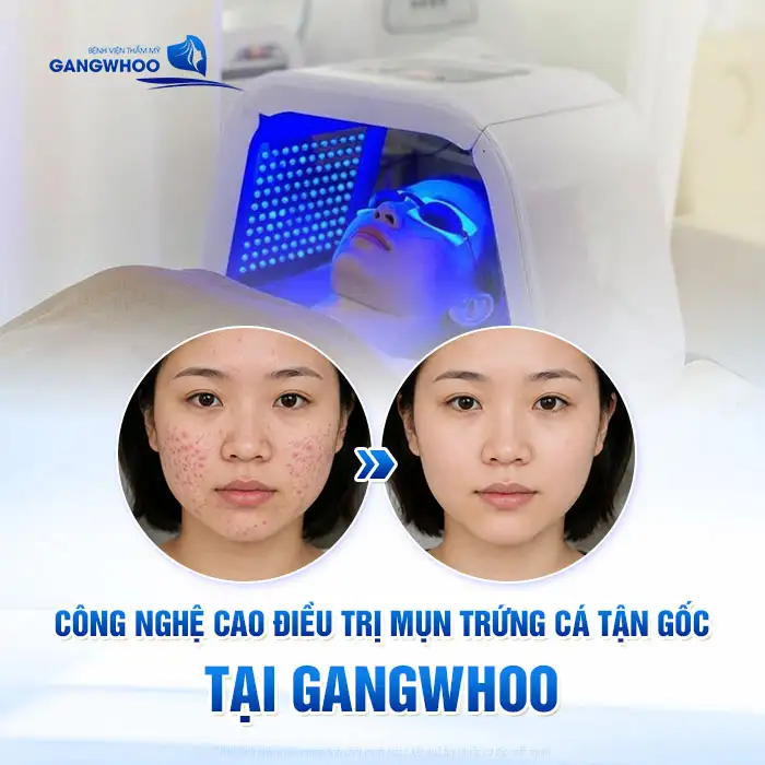 Cách điều trị mụn trứng cá đúng cách từ nhẹ đến nặng