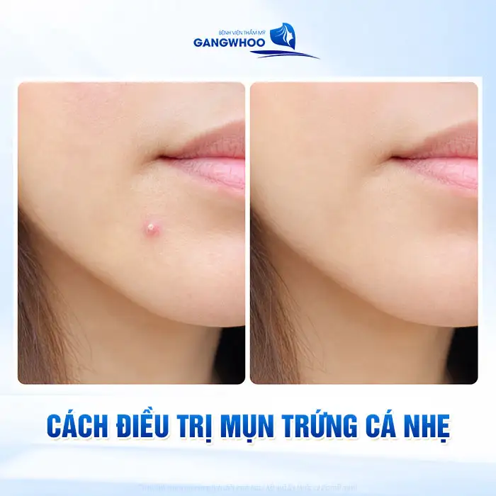 Cách điều trị mụn trứng cá đúng cách từ nhẹ đến nặng