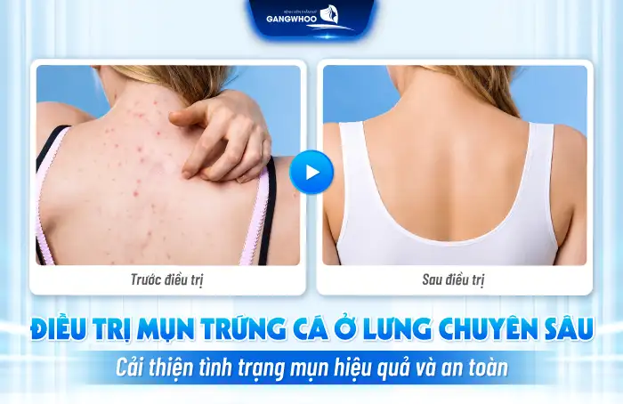 Cách điều trị mụn trứng cá ở lưng hiệu quả tại nhà và y khoa