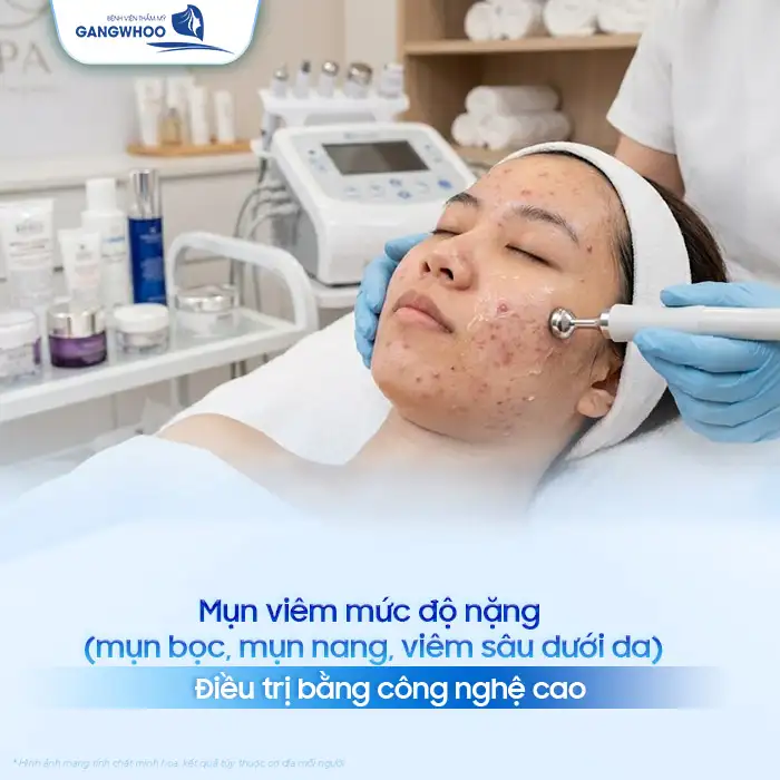 Cách điều trị mụn viêm hiệu quả, an toàn cho da mặt