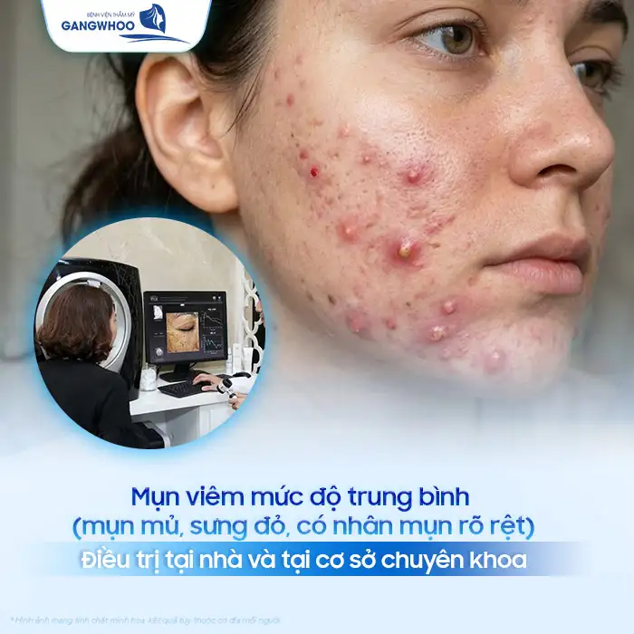 Cách điều trị mụn viêm hiệu quả, an toàn cho da mặt