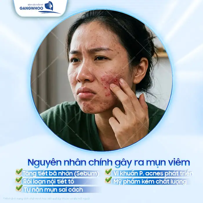 Cách điều trị mụn viêm hiệu quả, an toàn cho da mặt