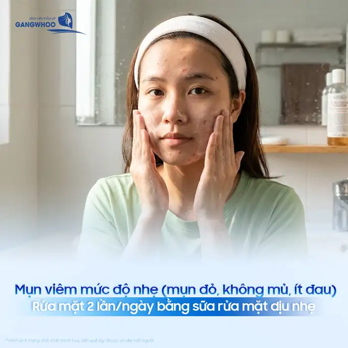 Cách điều trị mụn viêm hiệu quả, an toàn cho da mặt