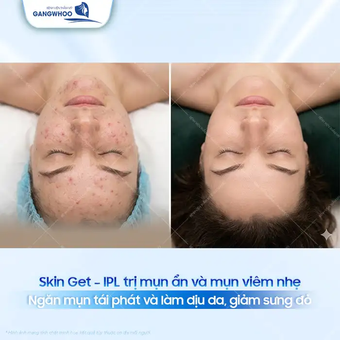 Cách điều trị mụn viêm hiệu quả, an toàn cho da mặt