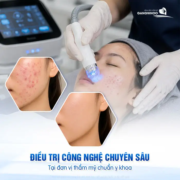 Cách điều trị phát ban mụn trứng cá an toàn và hiệu quả