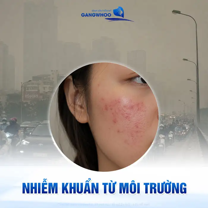 Cách điều trị phát ban mụn trứng cá an toàn và hiệu quả