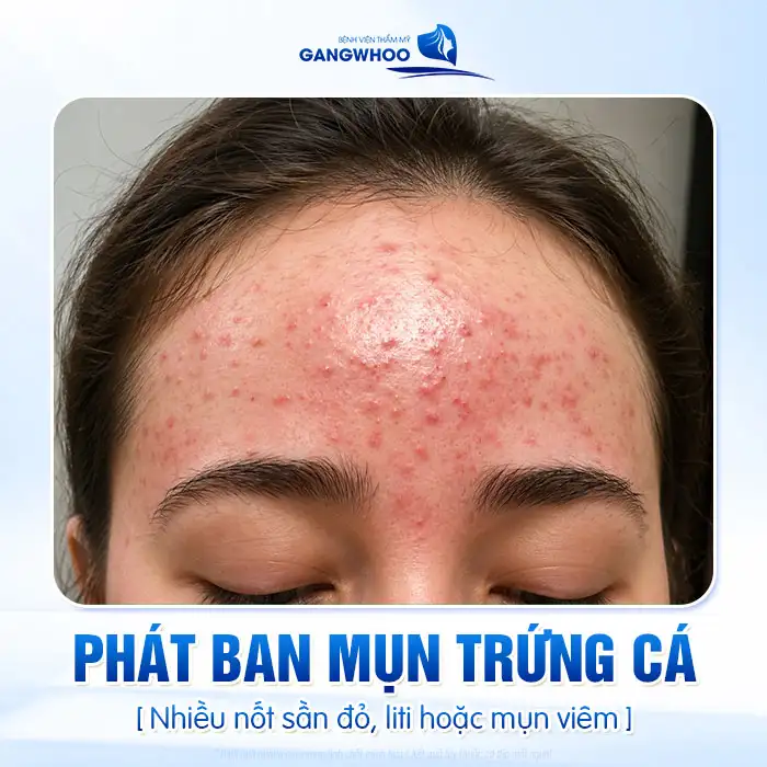 Cách điều trị phát ban mụn trứng cá an toàn và hiệu quả