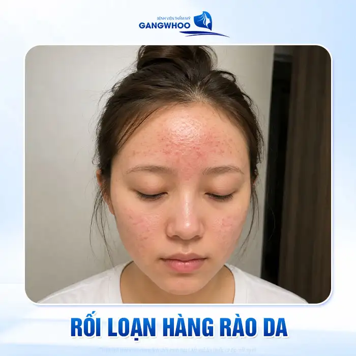 Cách điều trị phát ban mụn trứng cá an toàn và hiệu quả