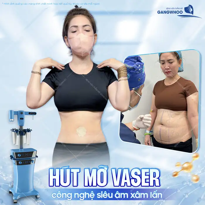 Tìm hiểu cách hút mỡ bụng hiệu quả, ít đau, giảm số đo nhanh chóng