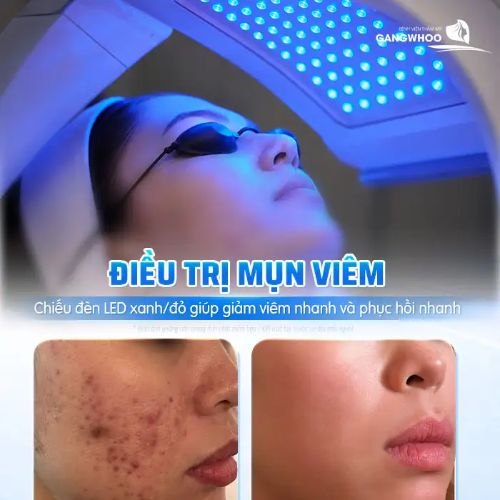 Các loại mụn và cách điều trị phù hợp cho từng tình trạng da