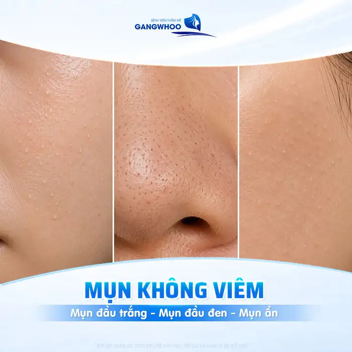 Các loại mụn và cách điều trị phù hợp cho từng tình trạng da