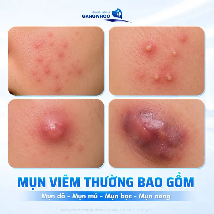 Các loại mụn và cách điều trị phù hợp cho từng tình trạng da